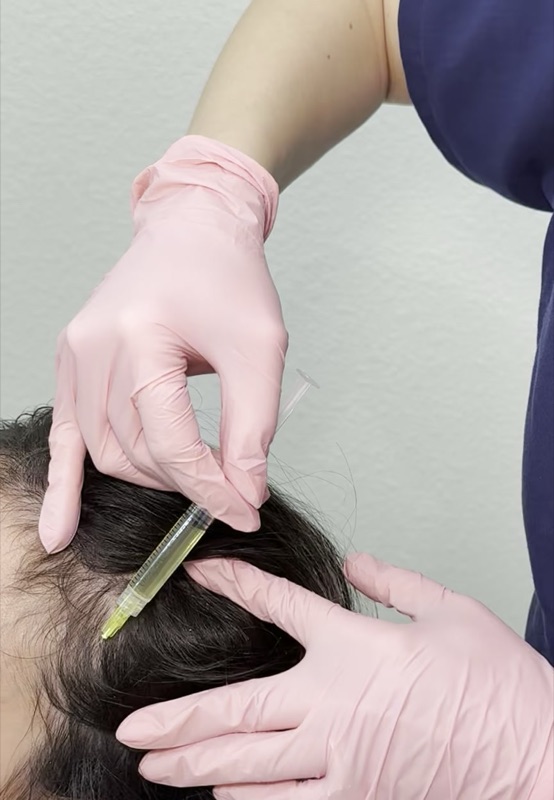 PRP injection for skin rejuvenation treatment at Chan Ramos MedSpa